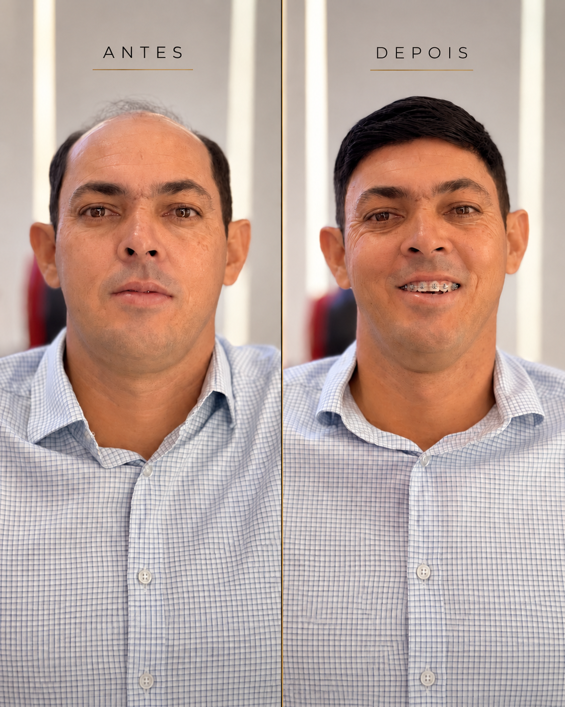 Prótese capilar em Garanhuns — Prime Capilar Clinic