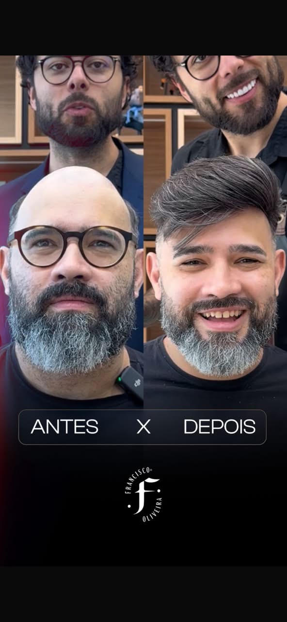 Prótese capilar — antes e depois