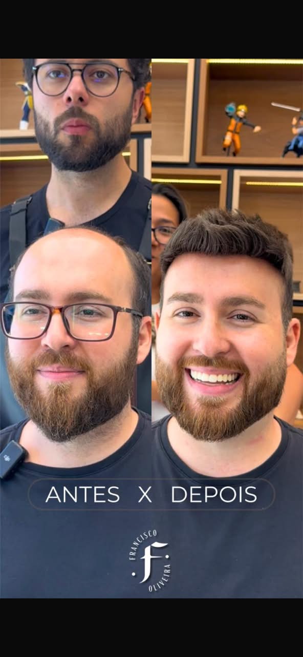 Prótese capilar — antes e depois